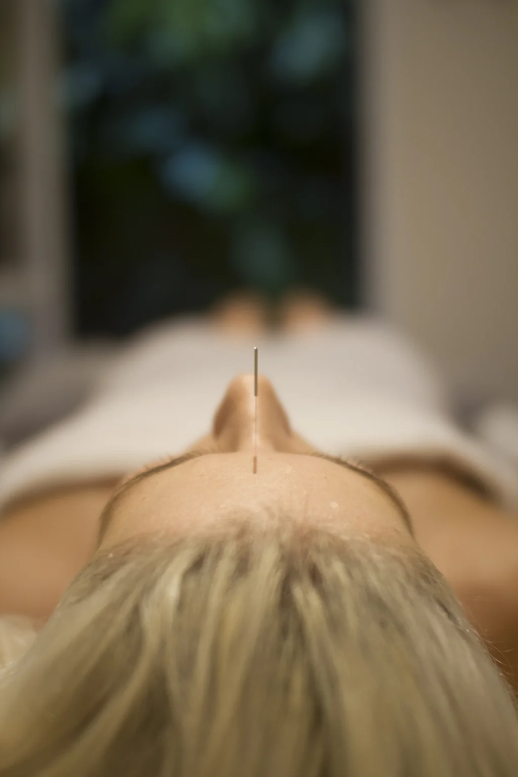 Sessão de acupuntura na Clínica Laura Proença